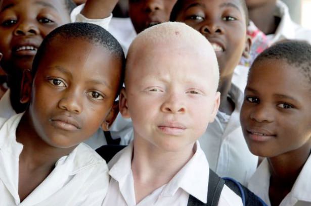 Tanzanya ve Afrika'da Albino Cinayetleri