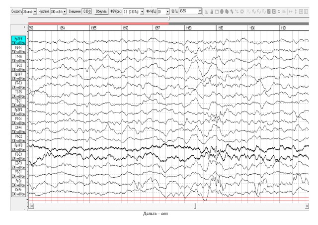 Ночной мониторинг ээг. ЭЭГ здорового ребенка 2 года. Таблица Графика ЭЭГ. Расшифровка ЭЭГ У детей 2 года. Электроэнцефалография человека график.